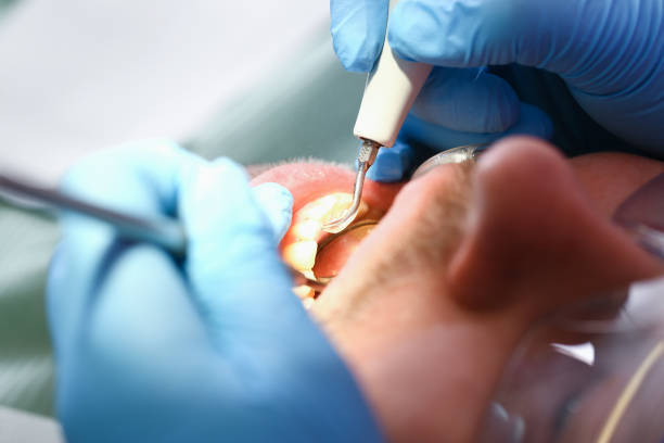 Best Emergency Wisdom Tooth Extraction in Farmington, MS